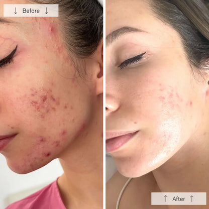 Omnilux Clear Acne