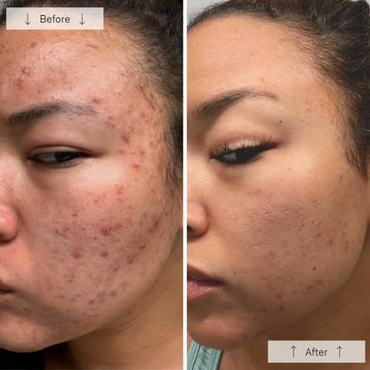 Omnilux Clear Acne