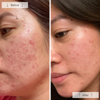Omnilux Clear Acne